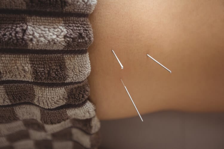 How To Find A Good Acupuncture Clinic