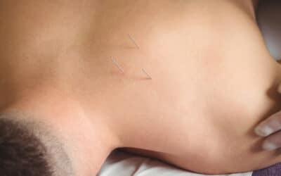 Acupuncture as a Sports Medicine