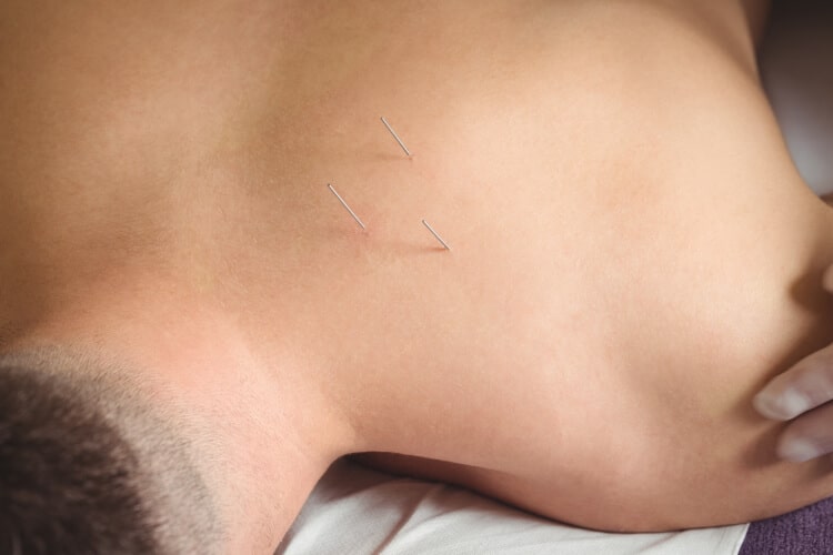 Acupuncture as a Sports Medicine