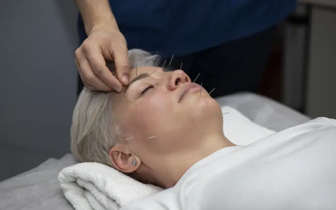 Facial Acupuncture: A Holistic Approach to Skin Health and Beauty